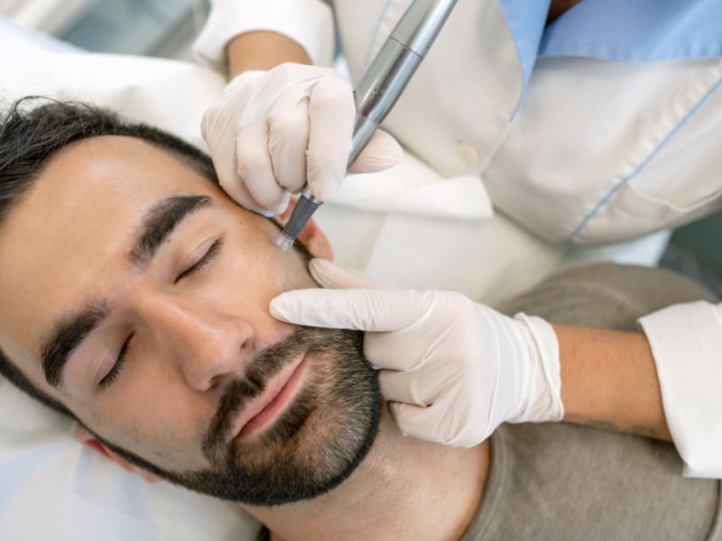 Microneedling-skin-treatment-men-women-the-skin-clinic-la