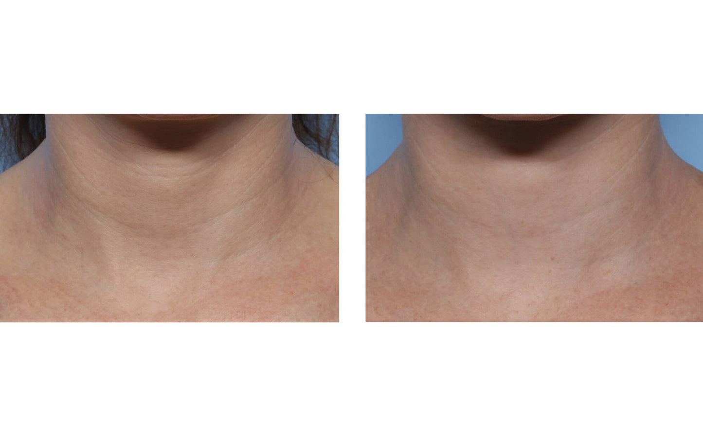 Techno Neck Perfecting Cream