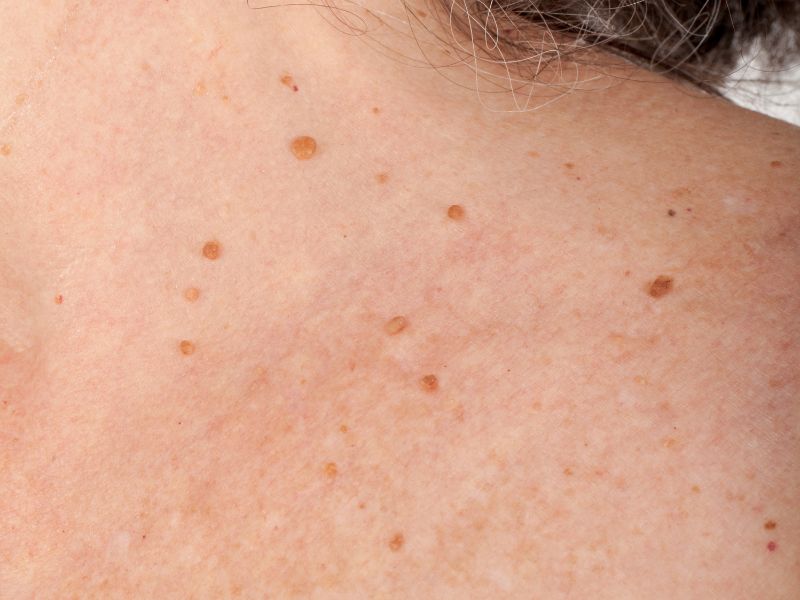 female skin with skin tags ready to receive hyfercator skin tag removal 