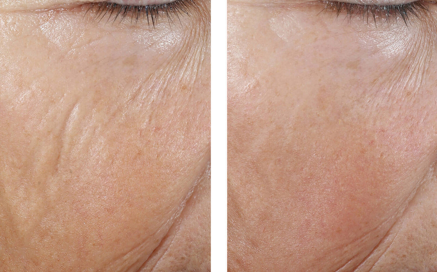 InterFuse Intensive Treatment LINES