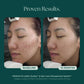 Duality™ Acne Treatment