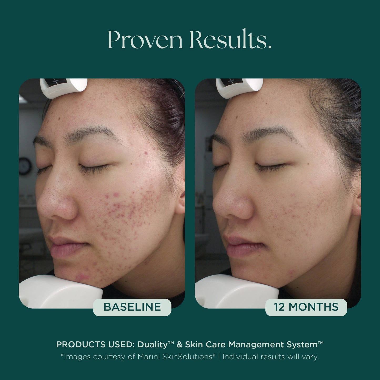 Duality™ Acne Treatment