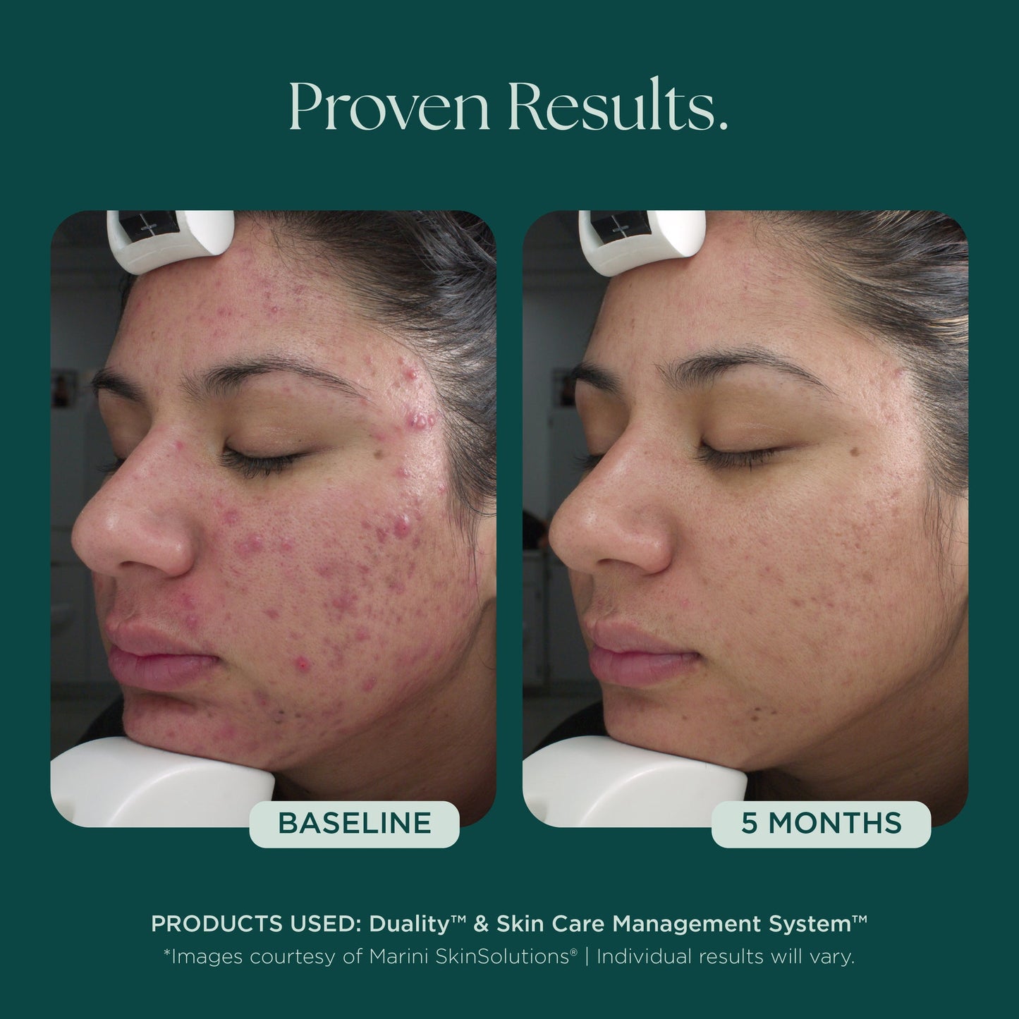 Duality™ Acne Treatment