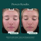 Duality™ Acne Treatment