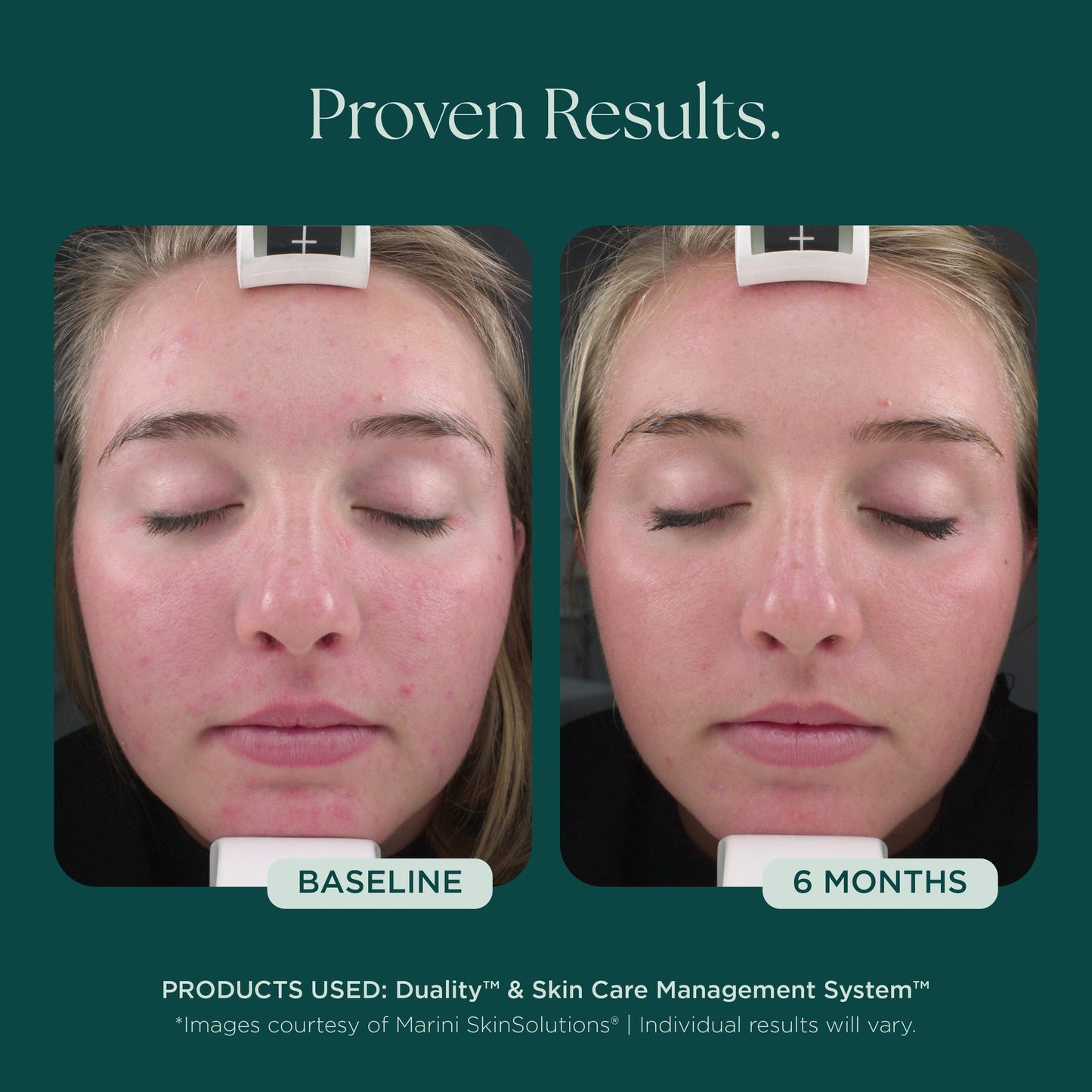 Duality™ Acne Treatment