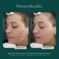 Duality™ Acne Treatment