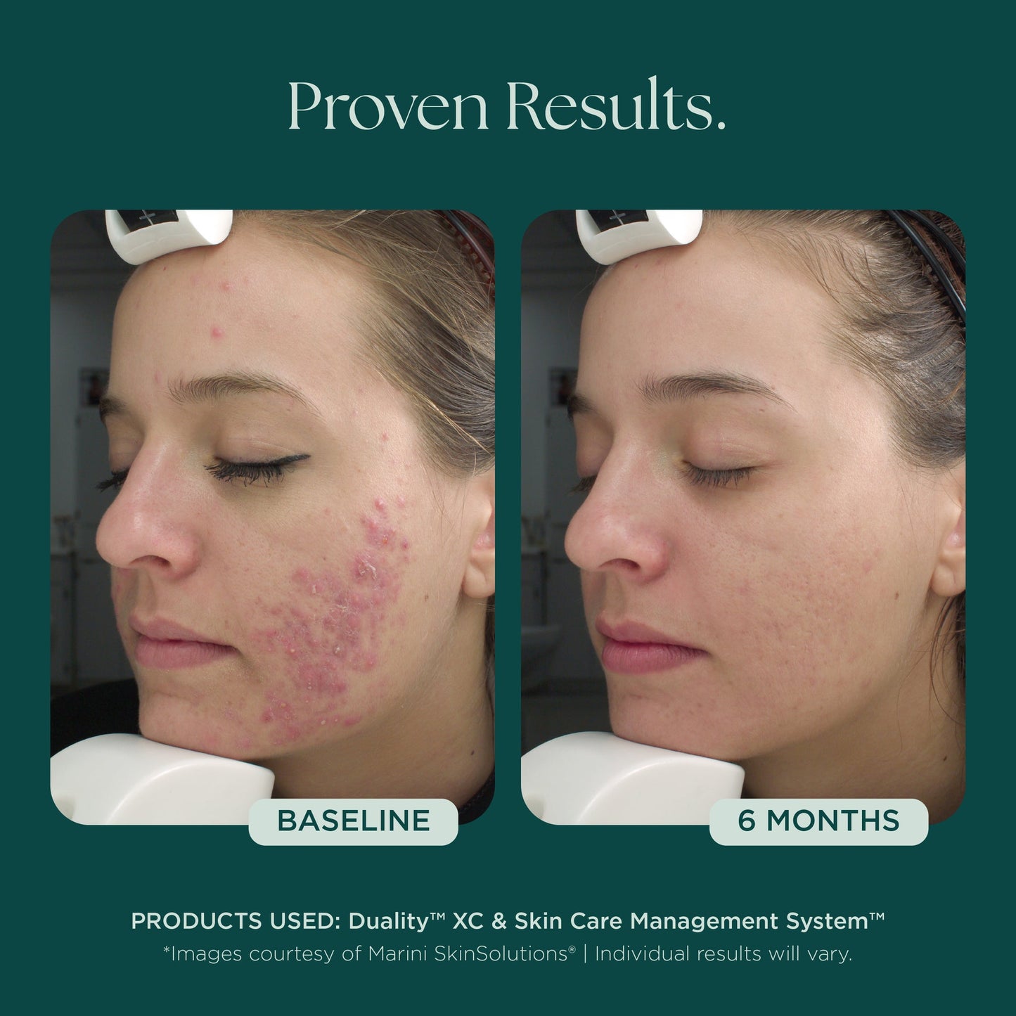 Duality™ Acne Treatment