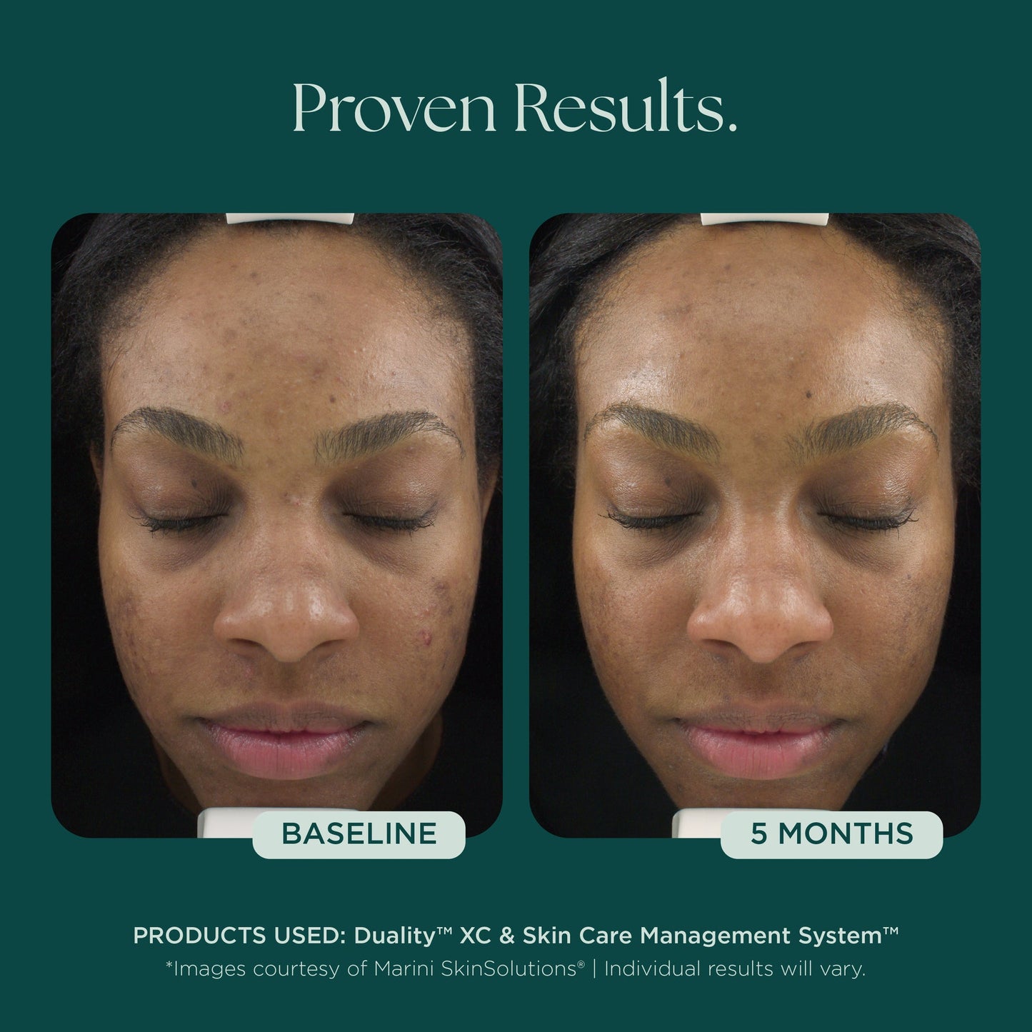 Duality™ Acne Treatment