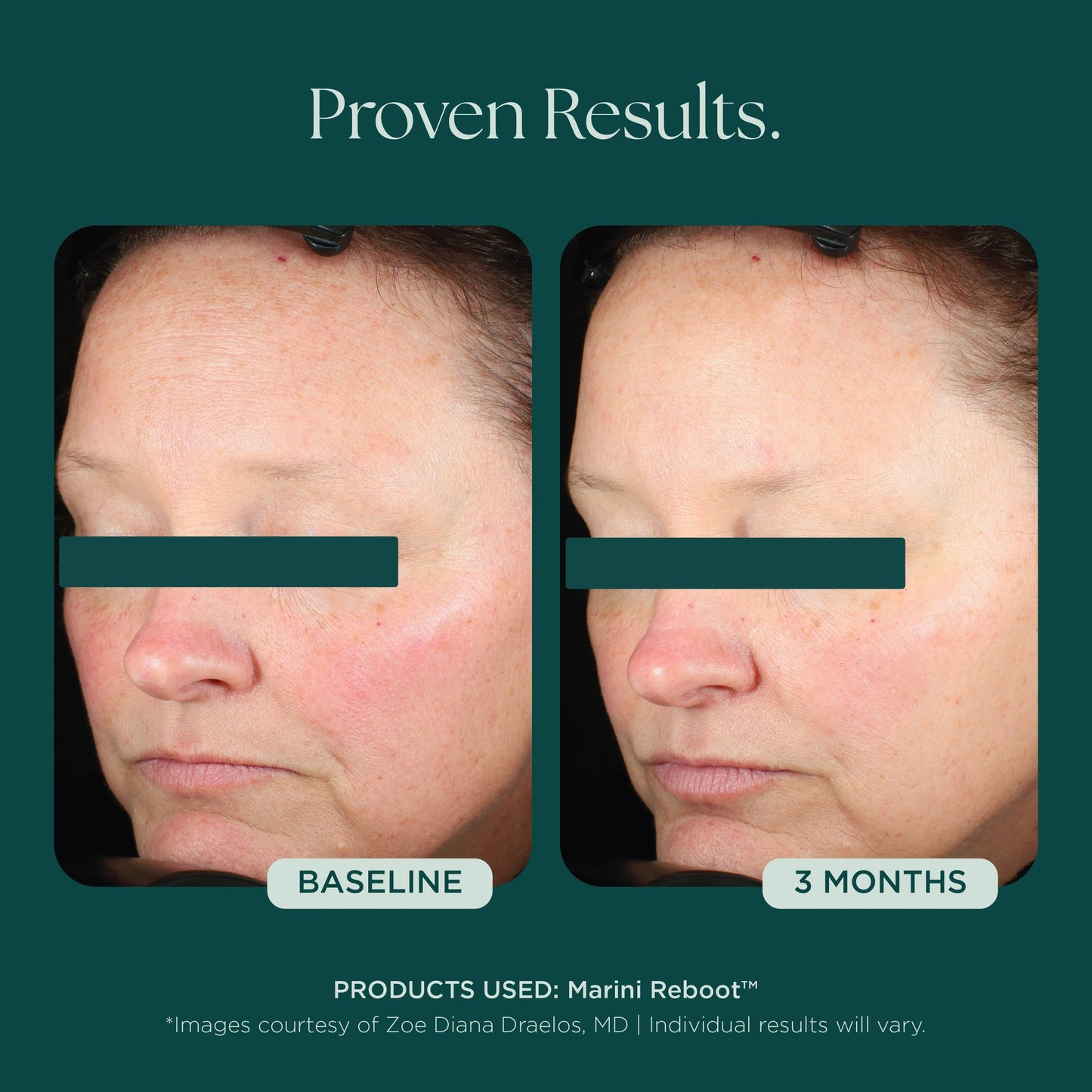 Reboot® PDRN Face Serum