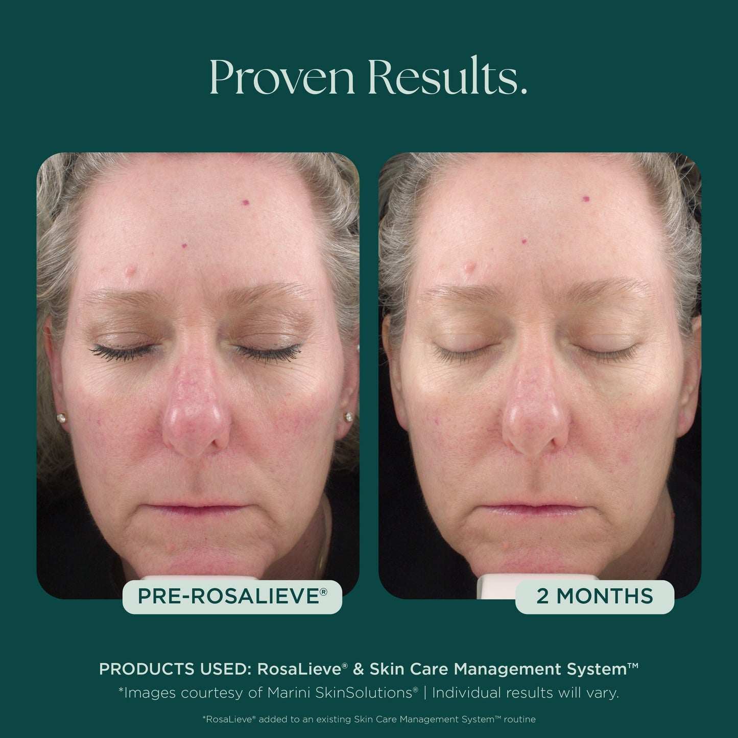 RosaLieve® Redness Reducing Complex