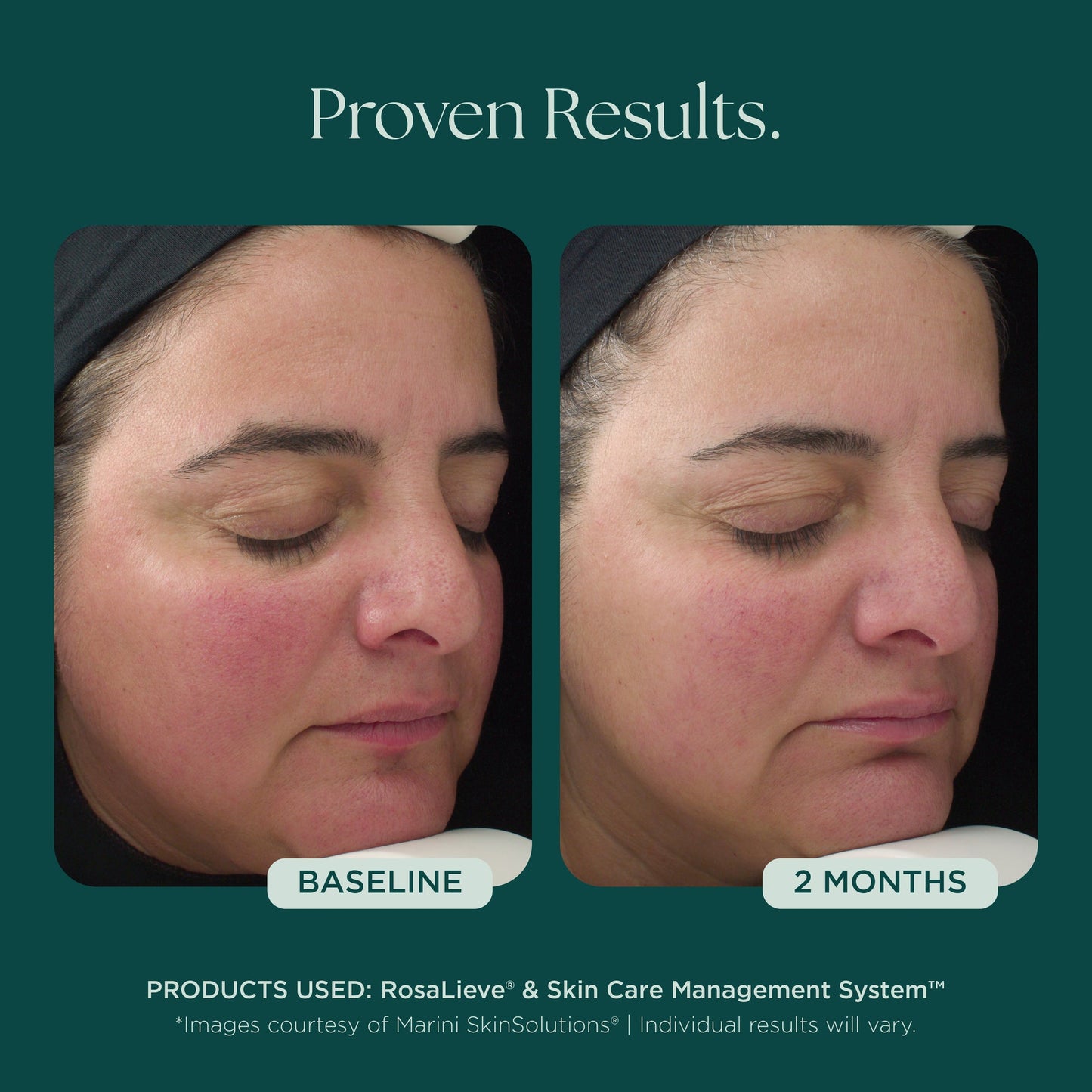 RosaLieve® Redness Reducing Complex