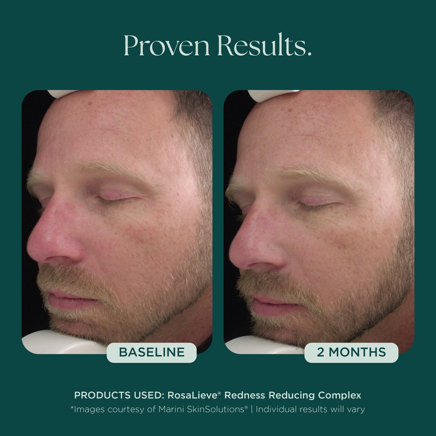 RosaLieve® Redness Reducing Complex