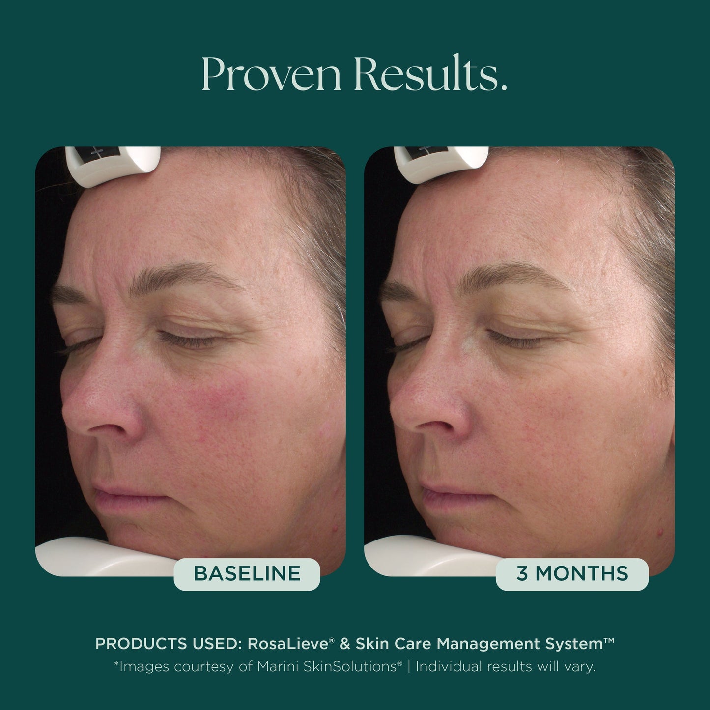 RosaLieve® Redness Reducing Complex