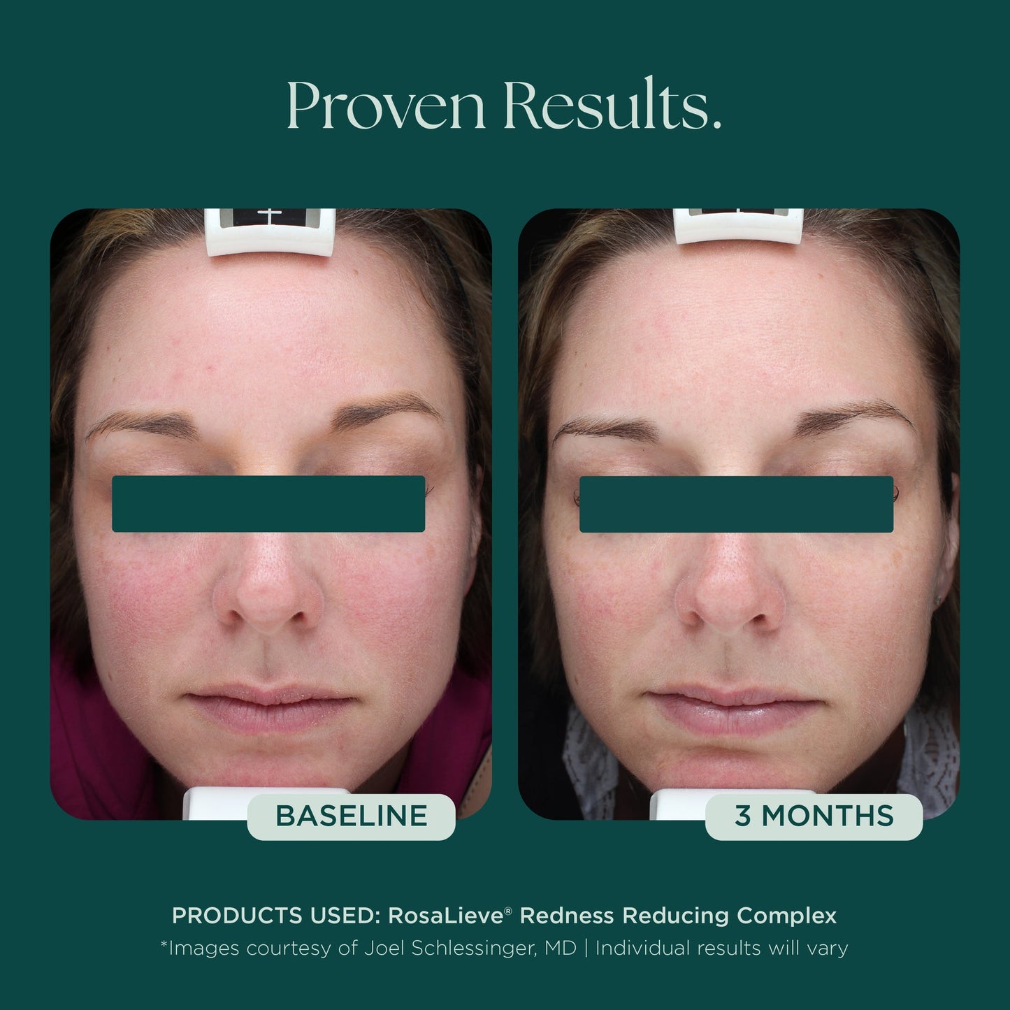 RosaLieve® Redness Reducing Complex
