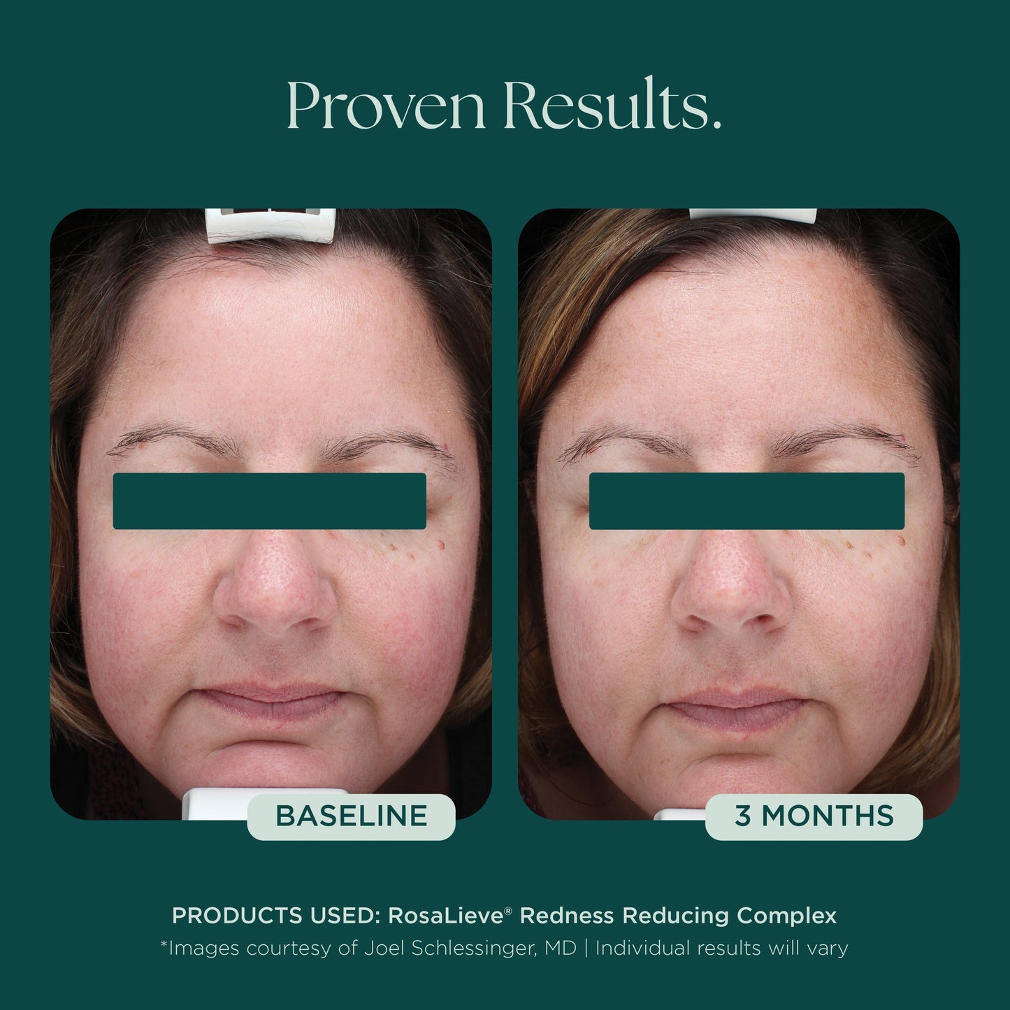 RosaLieve® Redness Reducing Complex