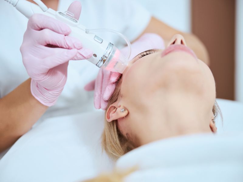 radio frequency microneedling service at the skin clinic LA