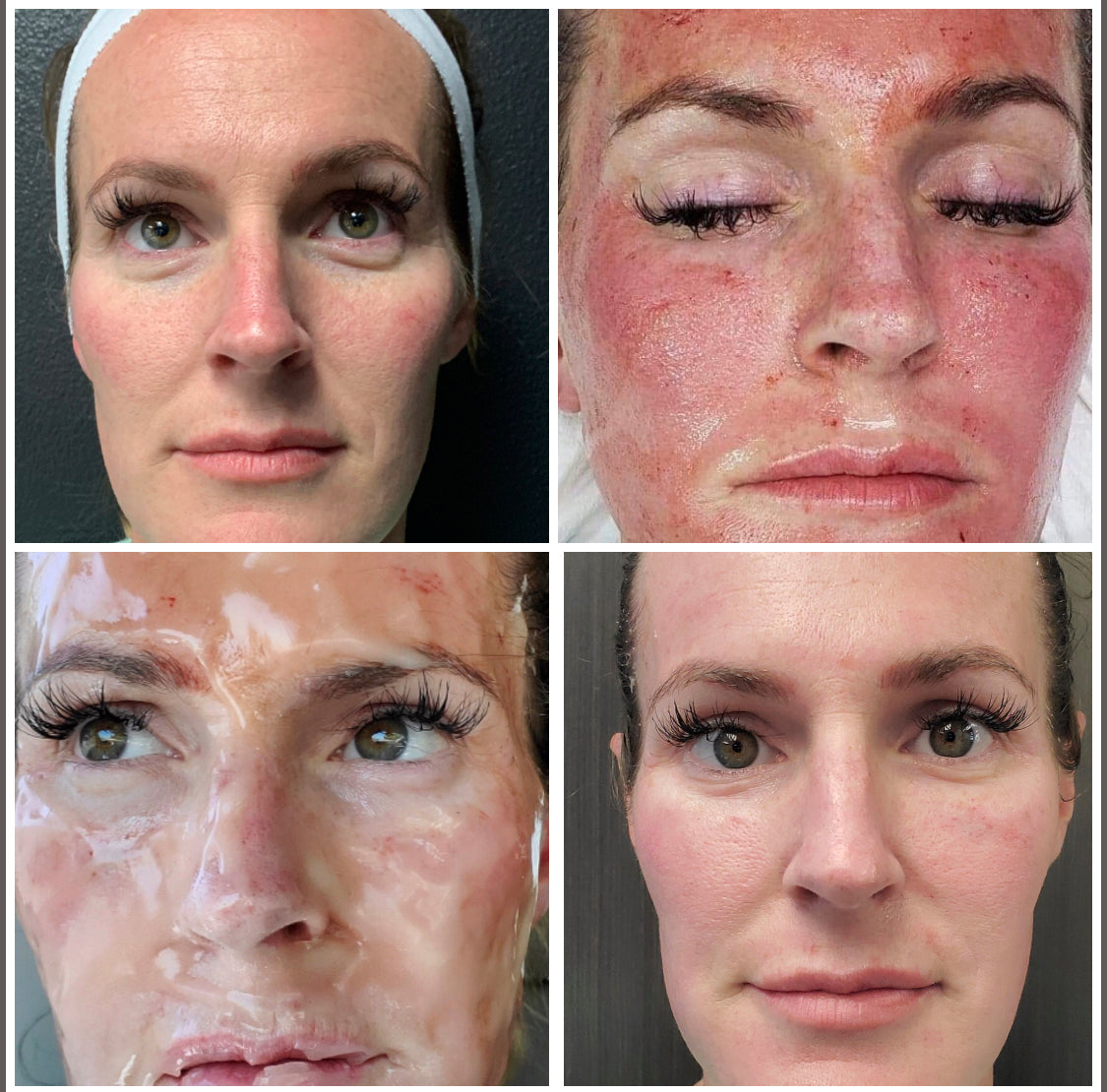 CO2Lift PRO Carboxy Gel Treatment